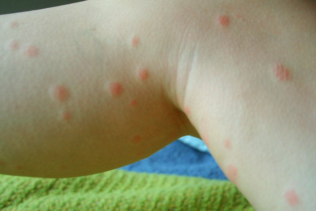 Blusų įkandimai: Priežastys, simptomai, gydymas ir prevencija 2 blusu ikandimai